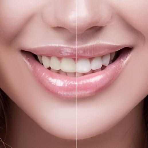 free laser teeth whitening with your exam and cleaning